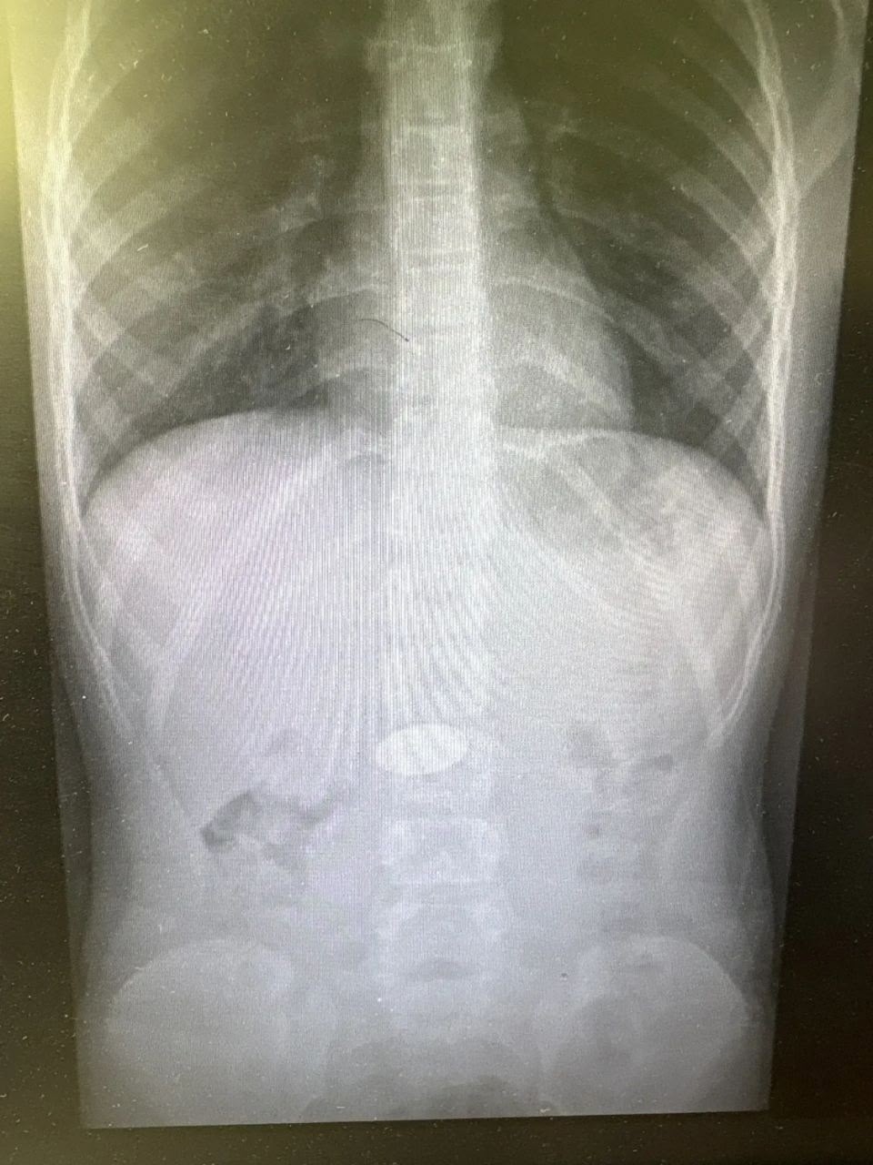 ❤️ Чудо в Волгограде: врачи спасли малыша, который проглотил 5‑рублёвую монету! в Волжском, 03.03.2026 в 11:30