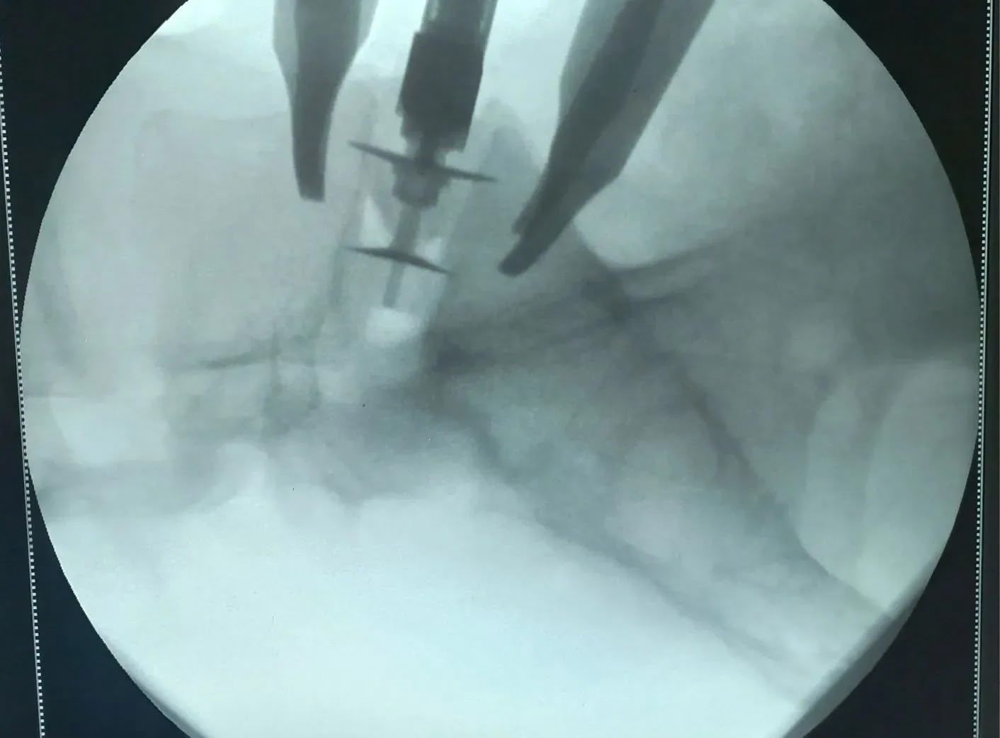 Новаторство в нейрохирургии: в Волгограде внедряют передовую методику лечения грыж межпозвонковых дисков! в Волжском, 09.04.2026 в 08:30